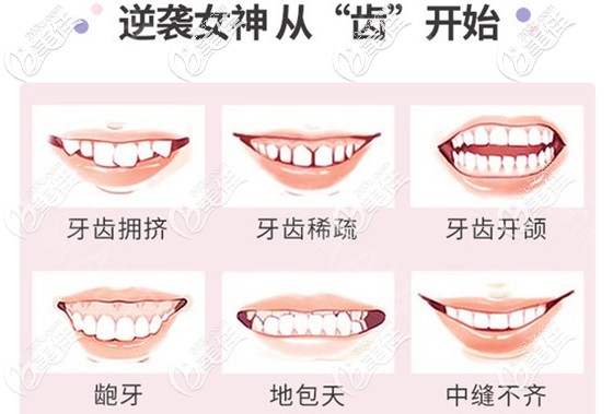 想顏值逆襲就從牙齒矯正開始吧 想顏值逆襲就從牙齒矯正開始吧