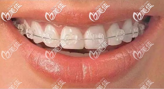 冰晶自鎖托槽矯正僅需14800元起 冰晶自鎖托槽矯正僅需14800元起