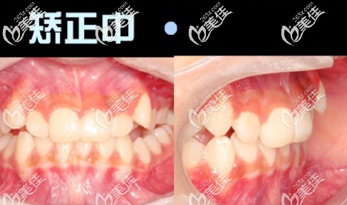 戴時代天使隱形牙套矯正地包天過程