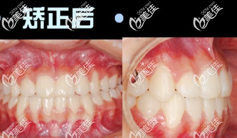 不要總問(wèn)我女兒在西安做地包天矯正的價(jià)格，先看看她戴時(shí)代天使隱形牙套的效果再說(shuō)