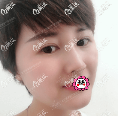 我做面部埋線提升的親身經(jīng)歷你了解完后就明白為什么我不后悔