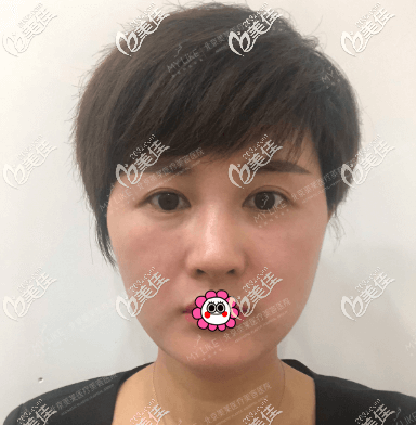 我的面部埋線提升親身經(jīng)歷告訴你為什么我不后悔 我的面部埋線提升親身經(jīng)歷告訴你為什么我不后悔
