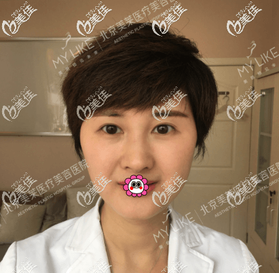 面部埋線提升一個多月的效果 面部埋線提升一個多月的效果