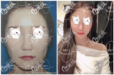 泰國(guó)咖蒙整形醫(yī)院下頜角手術(shù)案例