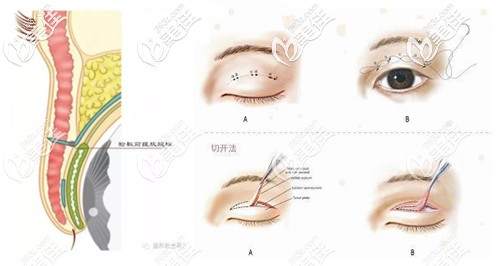 鄭祥奎醫(yī)生做眼部整形手術(shù)過程 鄭祥奎醫(yī)生做眼部整形手術(shù)過程