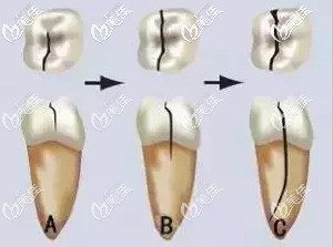 牙隱裂的從淺表到牙根的發(fā)展圖 牙隱裂的從淺表到牙根的發(fā)展圖