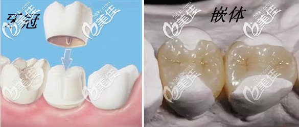 牙齒修復(fù)選嵌體和牙冠的示意圖 牙齒修復(fù)選嵌體和牙冠的示意圖
