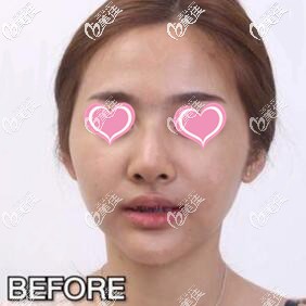 泰國隆鼻術(shù)前照 泰國隆鼻術(shù)前照