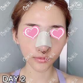 在泰國藝術(shù)整形外科隆鼻術(shù)后2天照 在泰國藝術(shù)整形外科隆鼻術(shù)后2天照