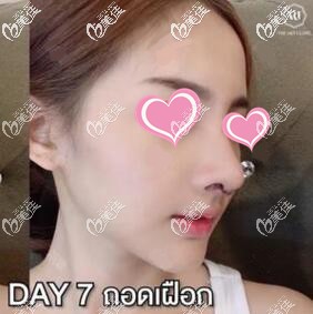 在泰國做隆鼻術(shù)后1周照 在泰國做隆鼻術(shù)后1周照