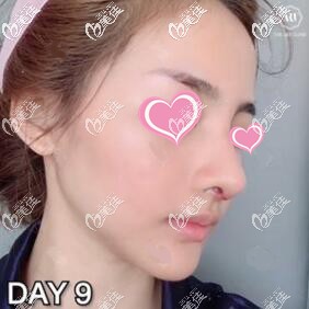 泰國藝術(shù)整形外科隆鼻真人術(shù)后9天恢復(fù)效果圖 泰國藝術(shù)整形外科隆鼻真人術(shù)后9天恢復(fù)效果圖