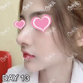 通過泰國藝術整形外科假體隆鼻真人案例來感受下泰國隆鼻技術怎么樣！