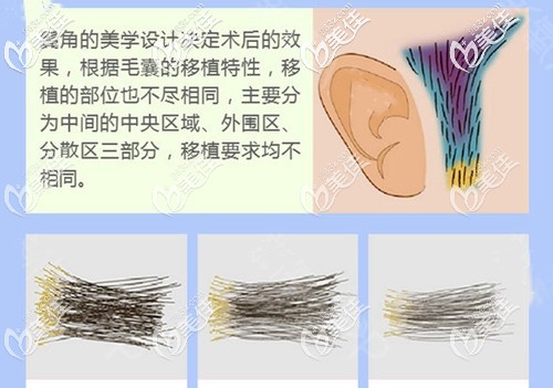 藝術(shù)毛囊移植鬢角手術(shù)