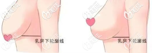 乳房下垂和乳房下移的區(qū)別