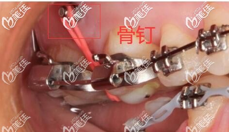 正畸打骨釘 正畸打骨釘