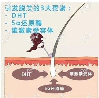 造成雄性脫發(fā)的主要原因