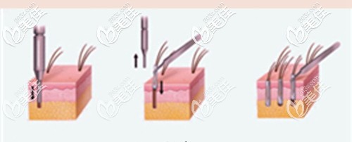 眉毛種植的過程原理