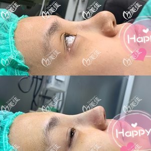 剛做完鼻綜合手術(shù)鼻子是高挺的