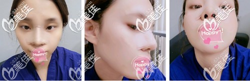 鼻綜合術(shù)后一周鼻子微腫