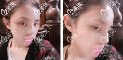 硅膠隆鼻+鼻翼縮小術(shù)后20天鼻子消腫