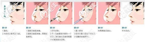 SARANON PAISANPAN醫(yī)生做硅膠隆鼻過程