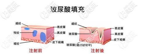 Natwadee Nimitkul醫(yī)生注射玻尿酸前后對比