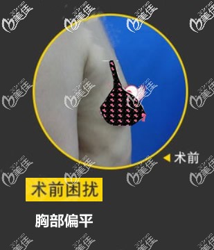 傲諾拉璀璨290假體隆胸前 傲諾拉璀璨290假體隆胸前