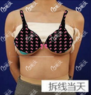 傲諾拉璀璨水滴形假體豐胸拆線后效果 傲諾拉璀璨水滴形假體豐胸拆線后效果