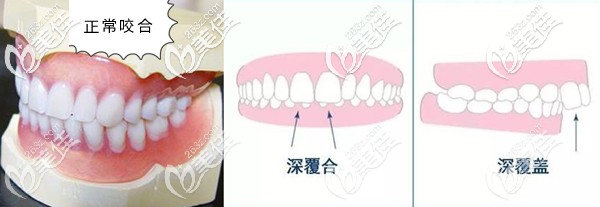 深覆合和深覆蓋的區(qū)別對比圖