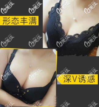 傲諾拉隆胸半年后恢復(fù)圖 傲諾拉隆胸半年后恢復(fù)圖