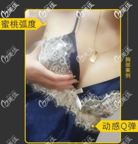 假體豐胸六個(gè)月效果 假體豐胸六個(gè)月效果