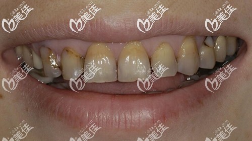 我的四環(huán)素牙 我的四環(huán)素牙