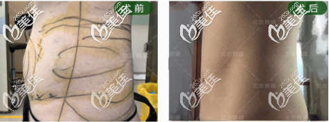 北京韓嘯醫(yī)療美容門診部腰腹減脂真人案例 北京韓嘯醫(yī)療美容門診部腰腹減脂真人案例