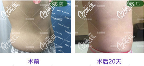 北京韓嘯腰腹吸脂真人案例 北京韓嘯腰腹吸脂真人案例