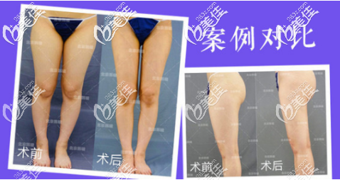 北京韓嘯大腿吸脂真人案例 北京韓嘯大腿吸脂真人案例