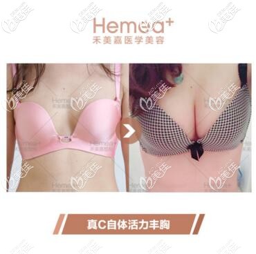 任學(xué)會(huì)真C自體活力豐胸真人前后對(duì)比照 任學(xué)會(huì)真C自體活力豐胸真人前后對(duì)比照