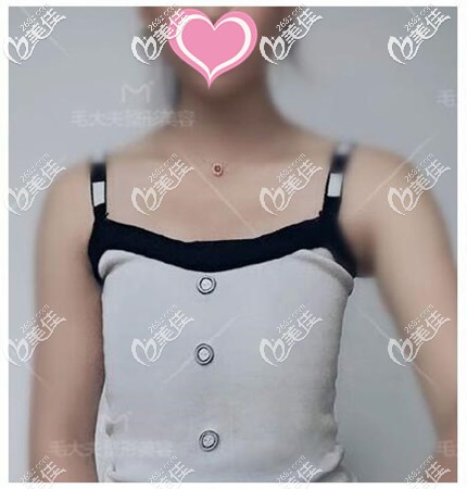 假體隆胸手術前 假體隆胸手術前