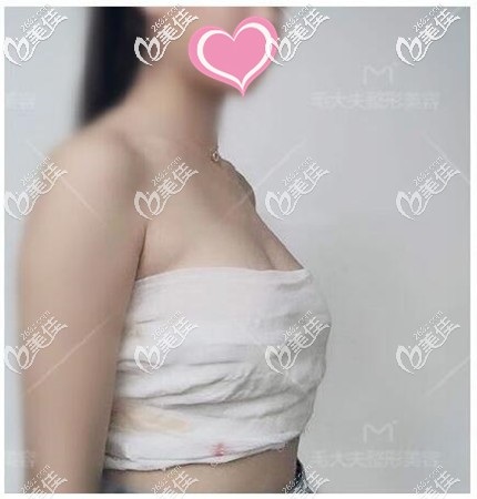 假體隆胸手術恢復期 假體隆胸手術恢復期