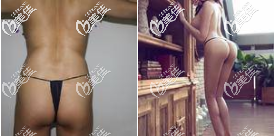 北京禾美嘉自體脂肪豐臀真人案例 北京禾美嘉自體脂肪豐臀真人案例