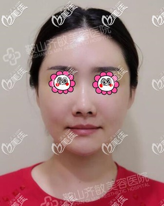 自體脂肪填充面部1個(gè)月時(shí)的<span style= 自體脂肪填充面部1個(gè)月時(shí)的<span style=