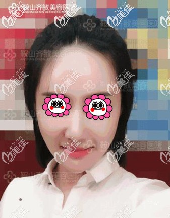 說實(shí)話我覺得我在鞍山做的自體脂肪填充面部效果就很不錯(cuò)，關(guān)鍵價(jià)格也不貴！