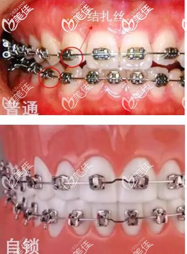 自鎖托槽和非自鎖區(qū)別 自鎖托槽和非自鎖區(qū)別