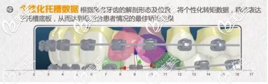 insignia精準(zhǔn)正畸個(gè)性化托槽 insignia精準(zhǔn)正畸個(gè)性化托槽