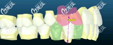 insignia精準(zhǔn)正畸3d可視化 insignia精準(zhǔn)正畸3d可視化