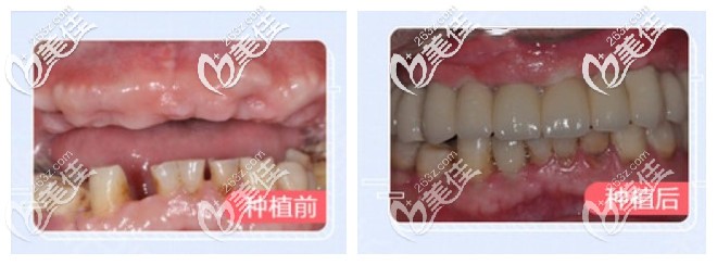 半口種植牙前后對比照