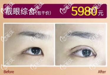 海南華美眼綜合真人前后對比案例圖