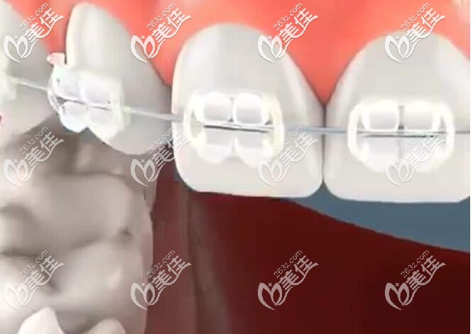 陶瓷托槽矯正 陶瓷托槽矯正