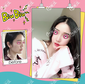 北京壹加壹張綠峰醫(yī)生鼻綜合隆鼻案例 北京壹加壹張綠峰醫(yī)生鼻綜合隆鼻案例