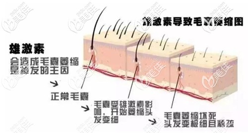 導(dǎo)致雄性脫發(fā)的主要原因