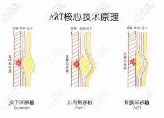 馮斌醫(yī)生的脂肪填充優(yōu)勢(shì) 馮斌醫(yī)生的脂肪填充優(yōu)勢(shì)